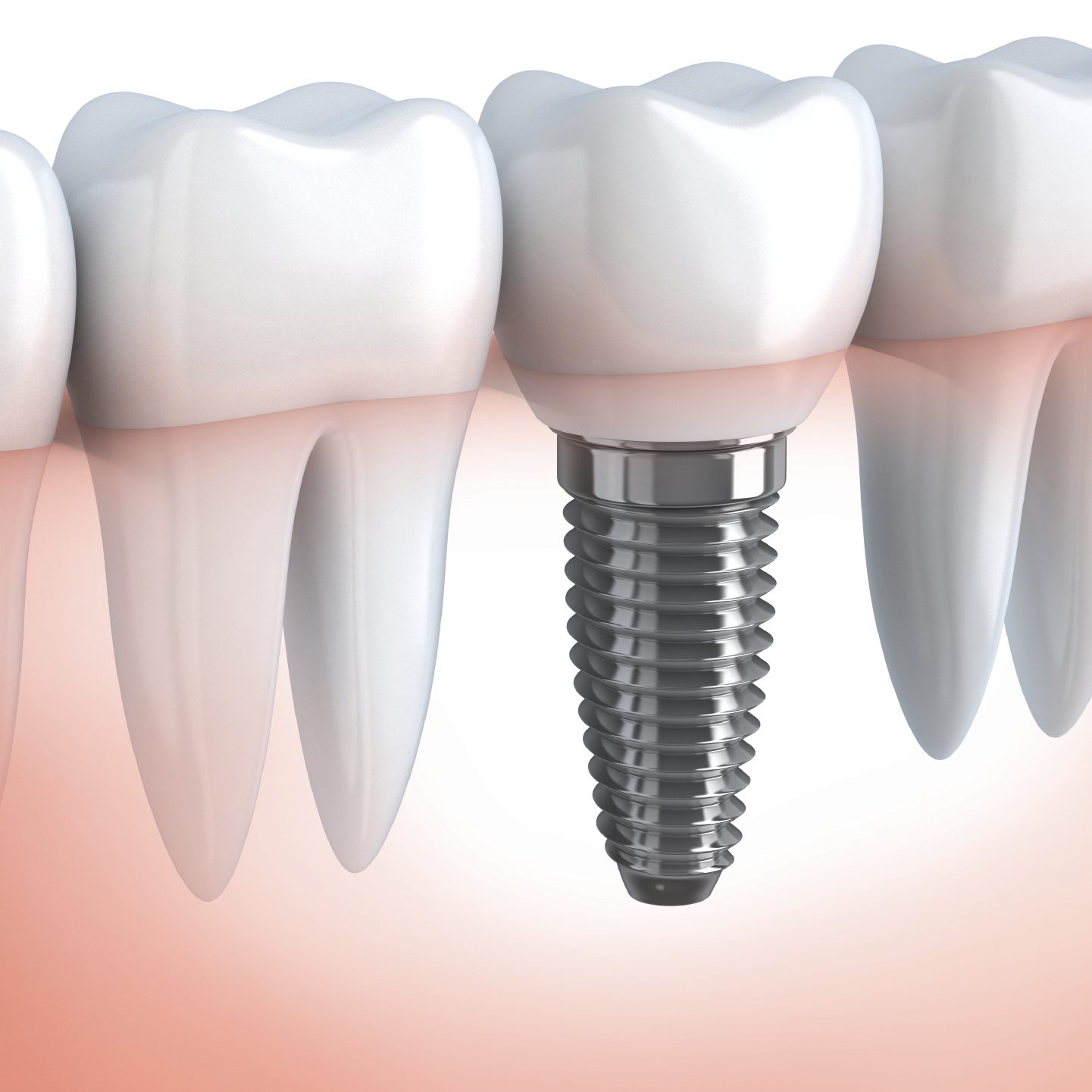 Dental Implants Toronto